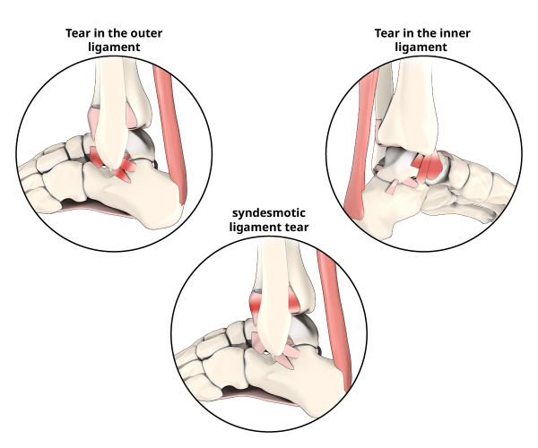 Illustration comparing tears of the lateral ligament, medial ligament and syndesmotic ligament