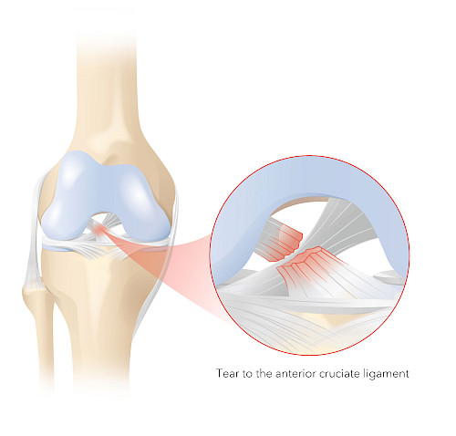 Illustrazione esplicativa di una lesione del legamento crociato