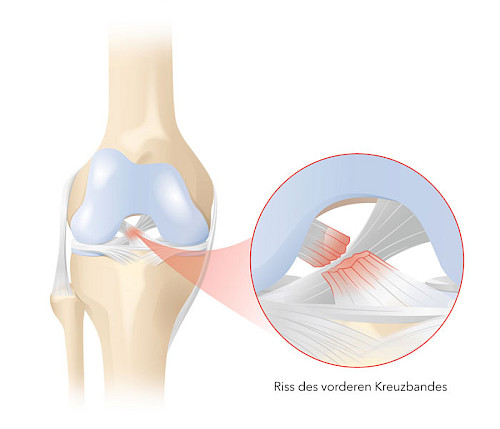 Grafik zur Erklärung von einem Kreuzbandriss