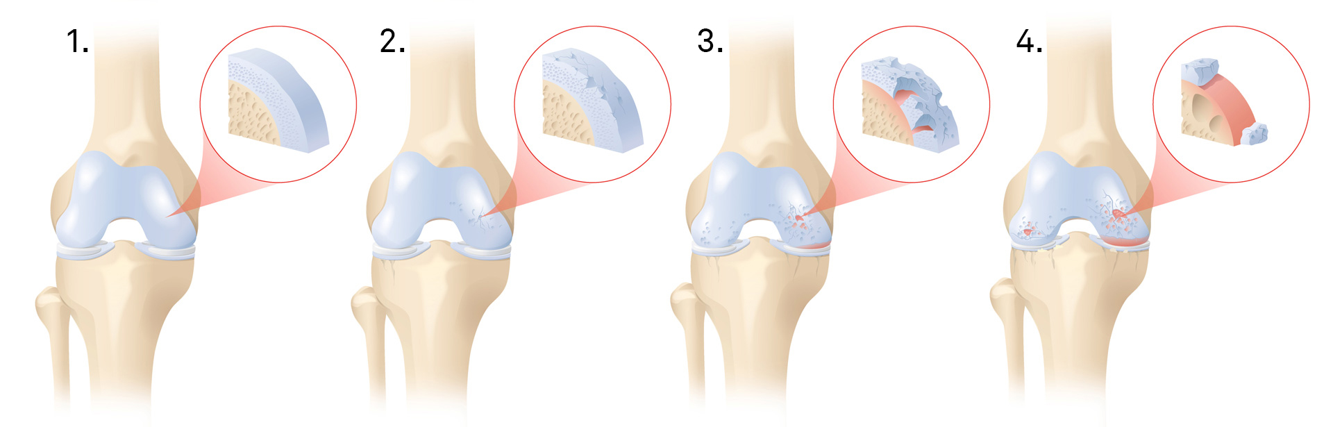 Lésion du cartilage - Informations sur la thérapie