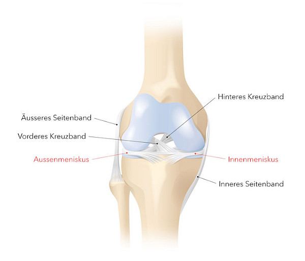 Grafik zur Lokalisation von Aussenmeniskus und Innenmeniskus