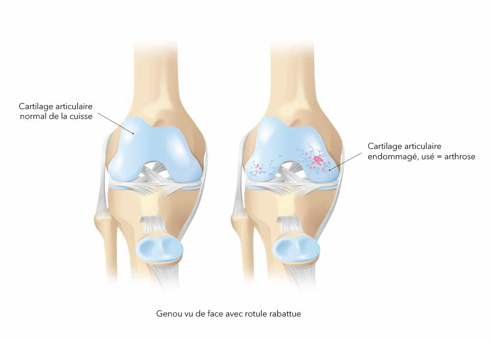 Arthrose du genou : symptômes, diagnostic et traitements