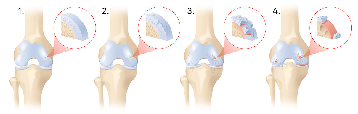 Illustration der 4 Stadien von einem Knorpelschaden