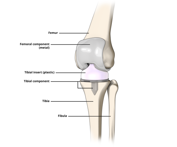 Illustration explaining a knee prosthesis