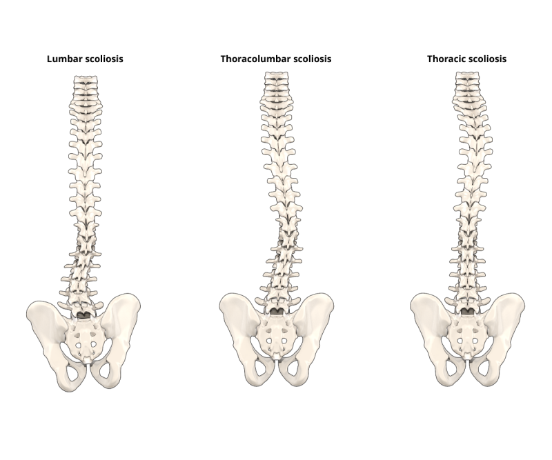 Illustration explaining the possible types of scoliosis
