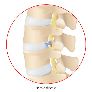 Graphique illustrant une hernie discale