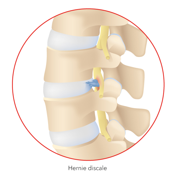 Hernie discale du rachis cervical - Informations sur le traitement