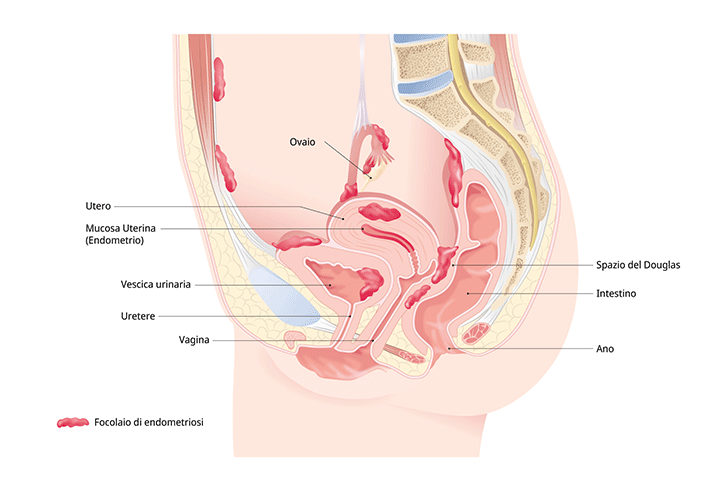 Endometriosi Causa e trattamento