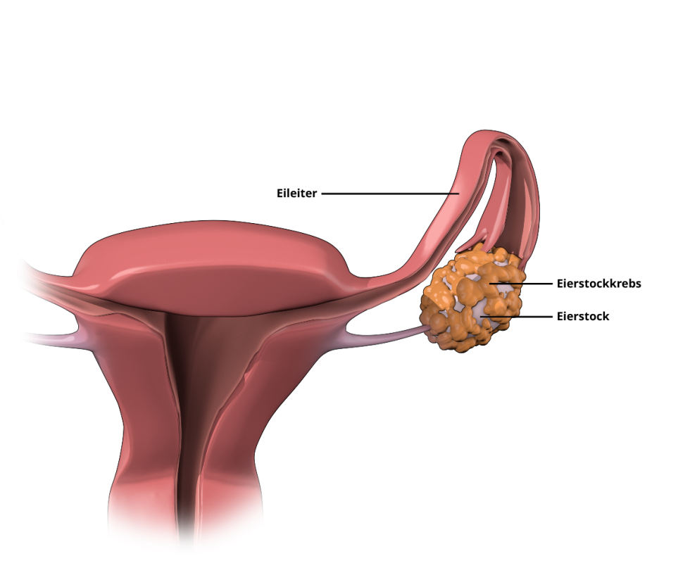 Grafische Darstellung zur Erklärung von Eierstockkrebs